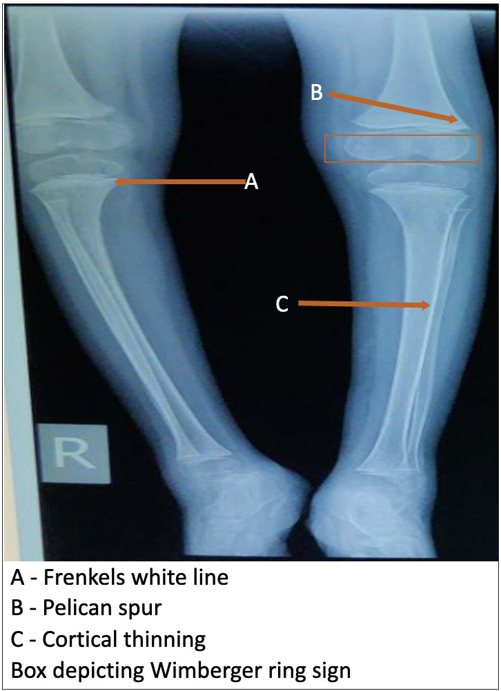 Radiograph of knee joint