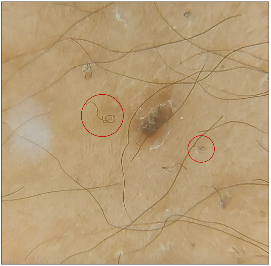 Dermoscopy showing coiled hair