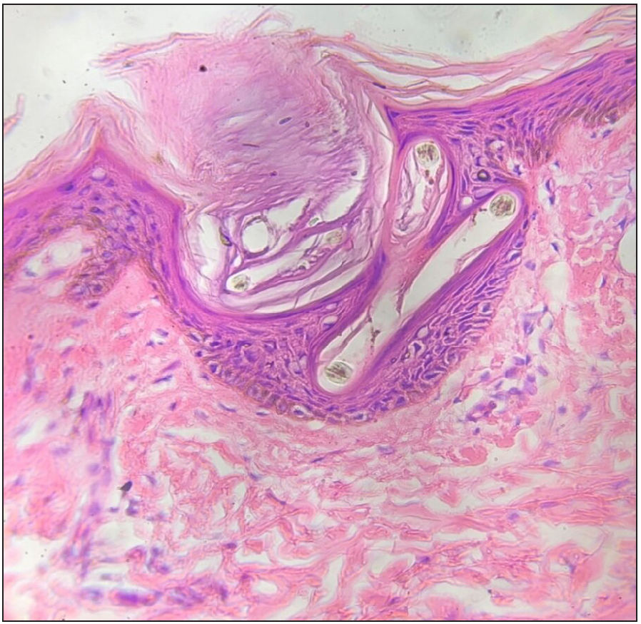 Histopathology showing follicular plugging and corkscrew hair in epidermis (40x H&E stain)