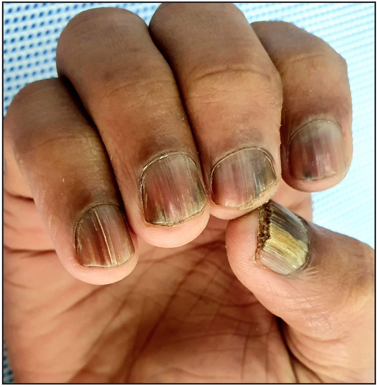 Cureus | Nail Whispers Revealing Dermatological and Systemic Secrets: An  Analysis of Nail Disorders Associated With Diverse Dermatological and  Systemic Conditions | Article