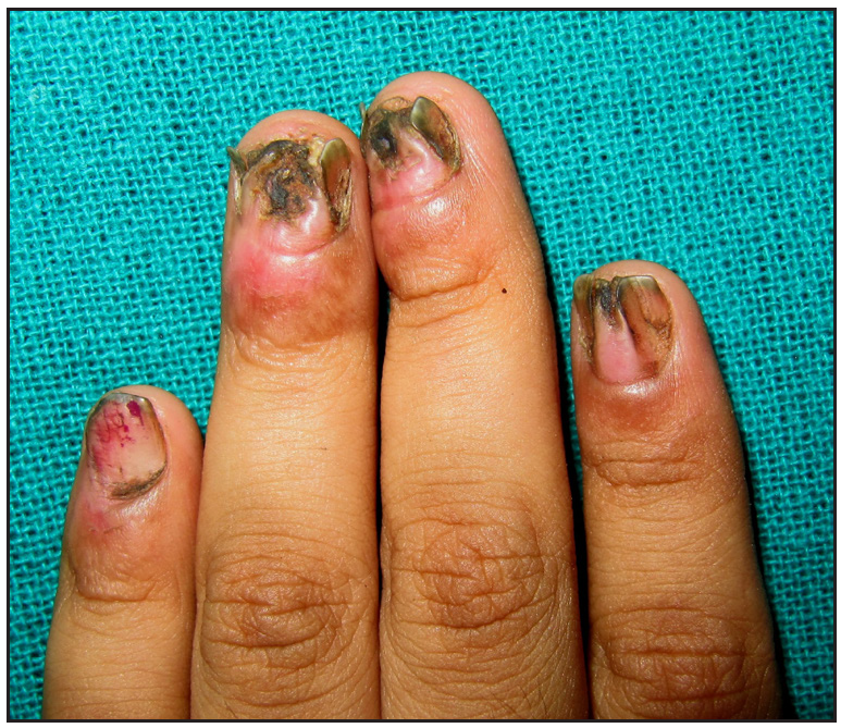 A) Lichen planus nail dystrophy with discoloration and fissuring of... |  Download Scientific Diagram