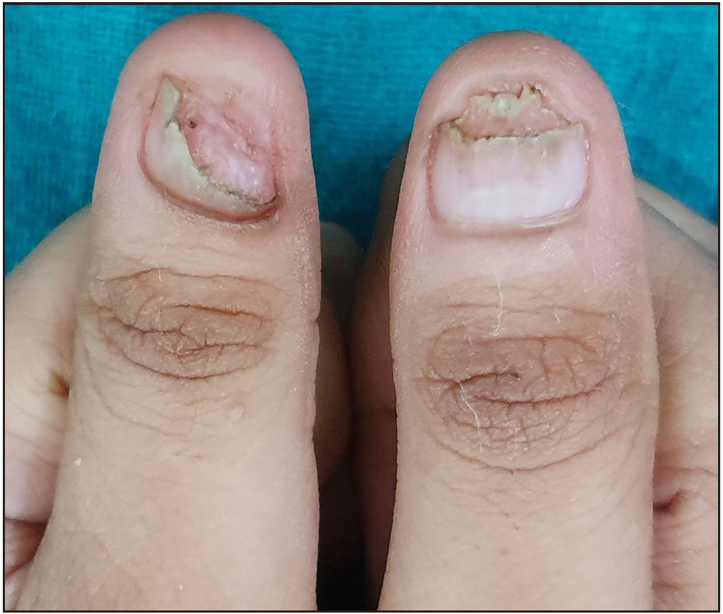 Skin and You » Fungal Nail Infections