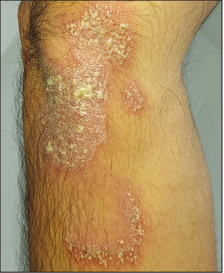 “Hypopyon” sign in dermatology - Indian Journal of Dermatology ...