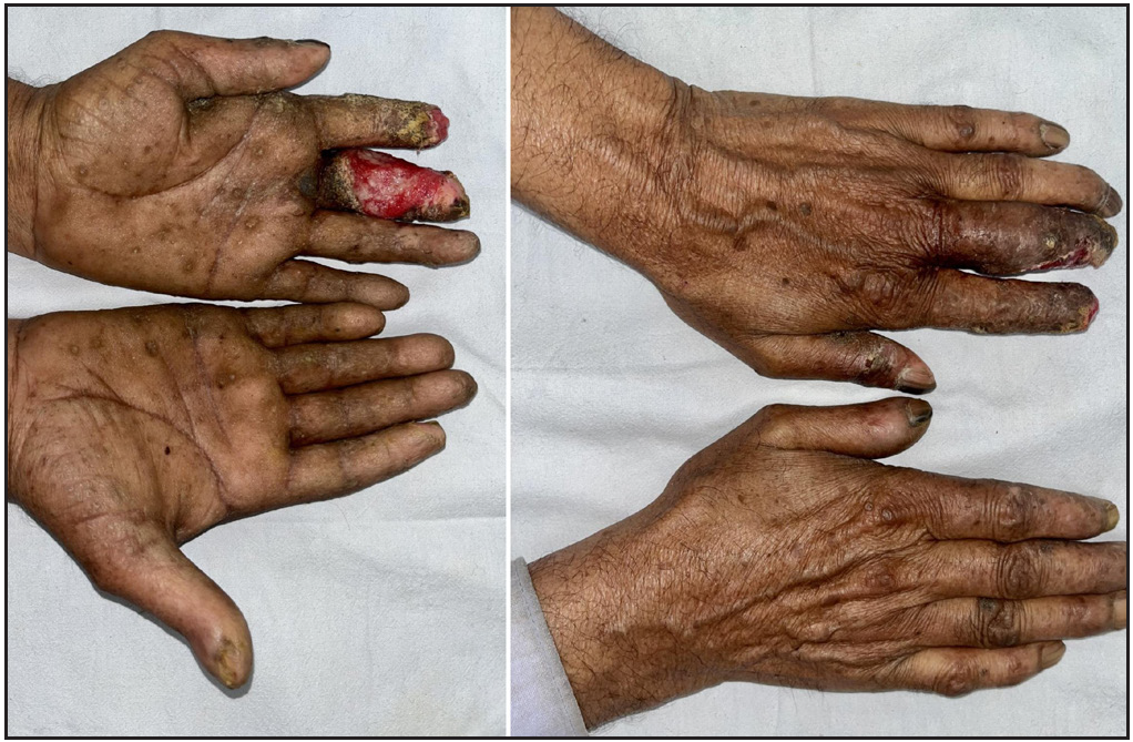 Well-defined ulcer on the palmar aspect of the left hand’s index and middle fingers, which was also partially extending to the dorsal aspect. The background skin revealed the presence of multiple hyperkeratotic papules and plaques.