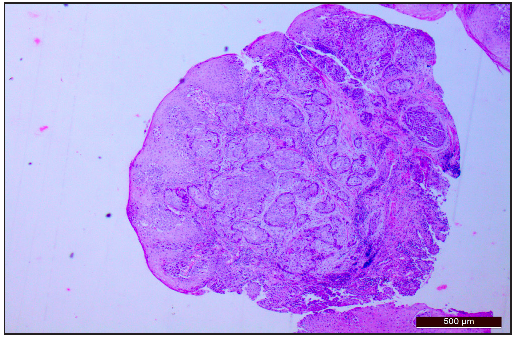 Epidermis showed marked hyperplasia, parakeratosis, and acanthosis with a focal dysplasia from which arising is a tumor arranged in sheets composed of polygonal cells with irregular hyperchromatic nuclei, moderate eosinophilic cytoplasm with focal squamous differentiation, suggestive of poorly differentiated squamous cell carcinoma (Hematoxylin and eosin; 40x).