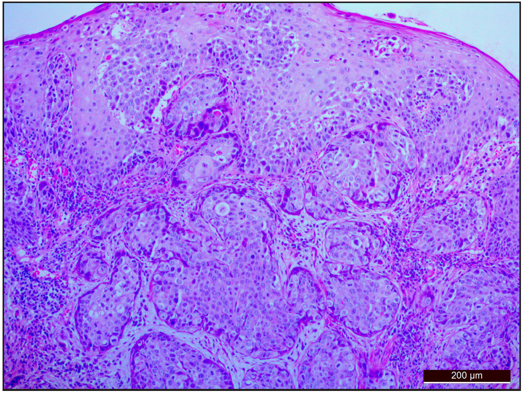 Epidermis showed marked hyperplasia, parakeratosis, and acanthosis with a focal dysplasia from which arising is a tumor arranged in sheets composed of polygonal cells with irregular hyperchromatic nuclei, moderate eosinophilic cytoplasm with focal squamous differentiation, suggestive of poorly differentiated squamous cell carcinoma (Hematoxylin and eosin; x100).