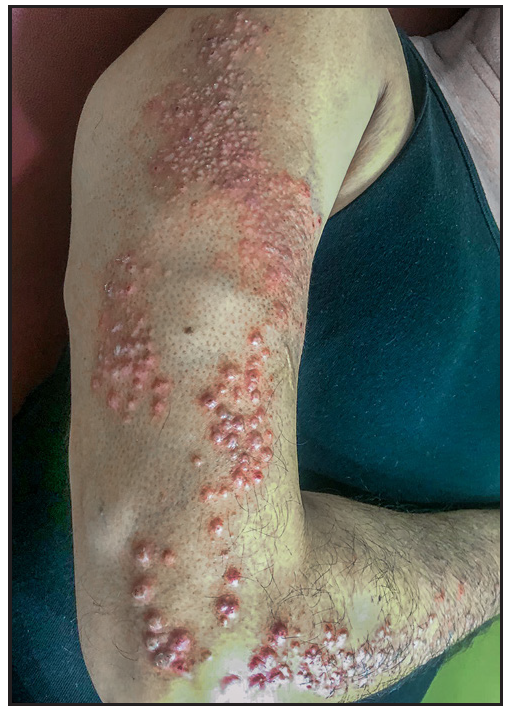 Closer picture of multiple reddish brown, firm, coalescing papules, some with superficial excoriations and perilesional erythema, demonstrating the Blaschkoid distribution on the upper arm.