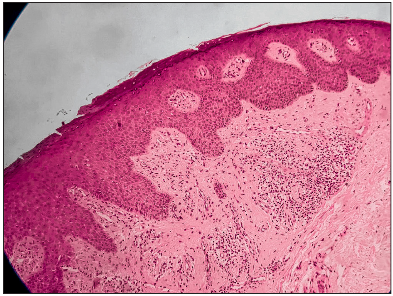 H& E- 100X - Acanthotic epidermis with hyperkeratosis and focal parakeratosis. Dermis shows mild fibrosis, thickened collagen bundles, and admixed perivascular lymphocytic infiltrate.