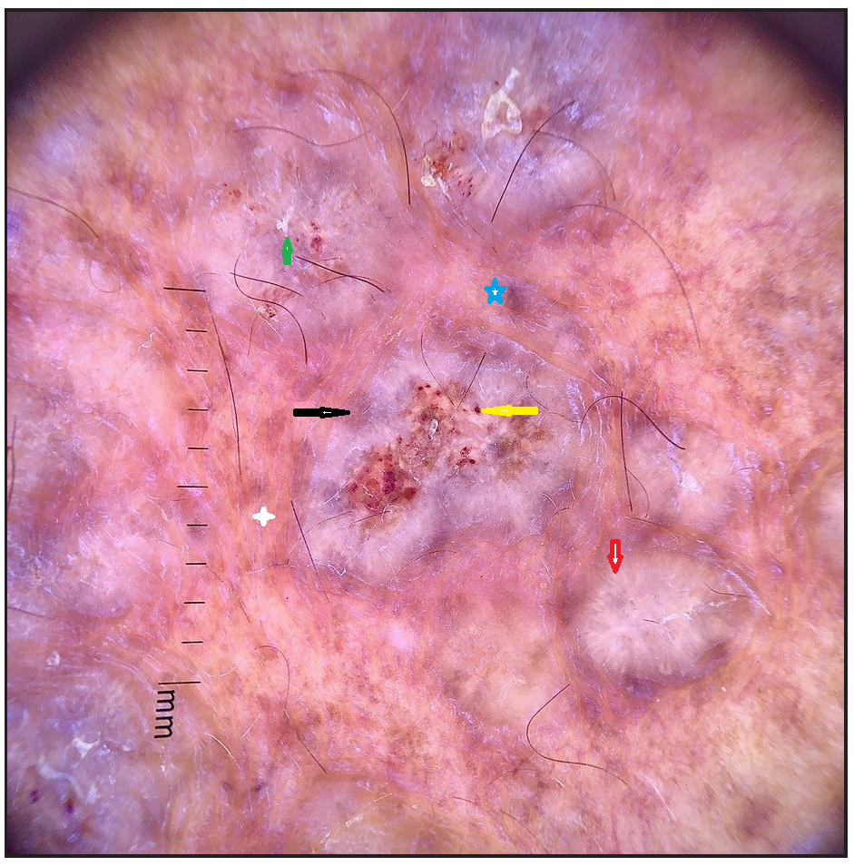 Polarised mode of dermoscopy. (Dermlite DL3Gen, USA). Annotations Red arrow – peripheral white striations giving white starburst pattern, Yellow arrow and Green arrow - scale, Black arrow - perilesional hyperpigmentation, White star – telangiectasia and atrophy, Blue star – blue grey globule