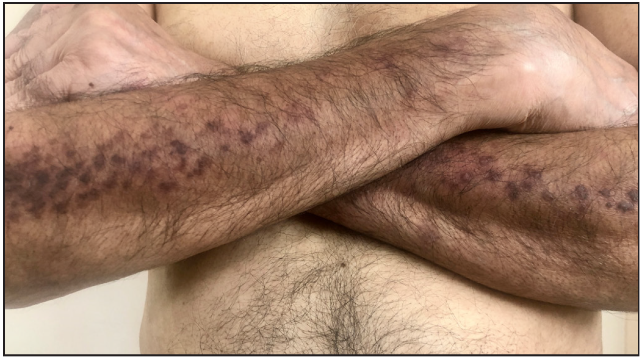 Significantly resolved and flattened lesions with post-inflammatory hyperpigmentation.