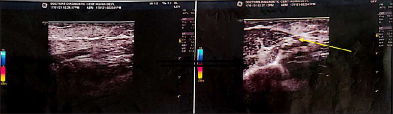 Colour Doppler showing hyperechoic thrombus (yellow arrow) in a subcutaneous vessel on right upper arm and forearm without any colour flow