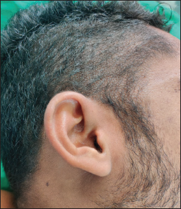 Clinical presentation of Lipoid proteinosis (a) Pin-point papules on scalp