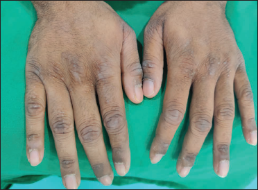 Beaded papules with hyperpigmentation over dorsum of bilateral hands