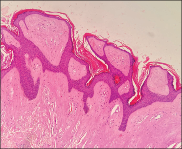 Histopathology showing hyperkeratosis, papillomatosis and amorphous deposits in upper dermis (H and E, ×40)