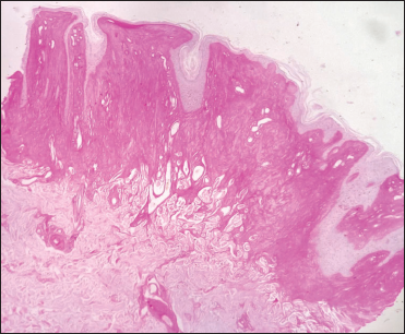 PAS-positive deposition in upper dermis (PAS, ×40)