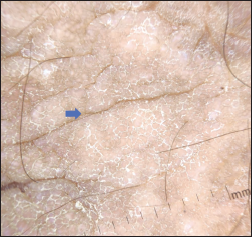 Bluish-purple globules with scaling in fissures and hemorrhagic crust over the elbow (blue arrow), Dermlite DL3, ×10