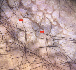 Pearly beaded globules (red arrow) clustered over the intergluteal cleft, polarised mode (Dermlite DL3, ×10)