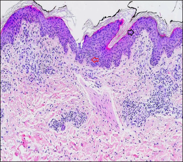 Skin biopsy from an erythematous plaque on the thigh of a patient with coronavirus disease-2019 showing exocytosis (black arrow), focal spongiosis (red arrow) and superficial perivascular lymphocytic infiltrate (H&E, ×100)