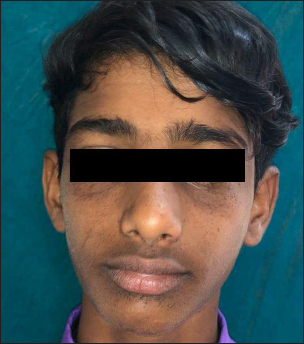 Second patient with baseline Facial Angiofibroma Severity Index-5