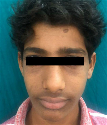 Second patient improving to Facial Angiofibroma Severity Index-3 after treatment