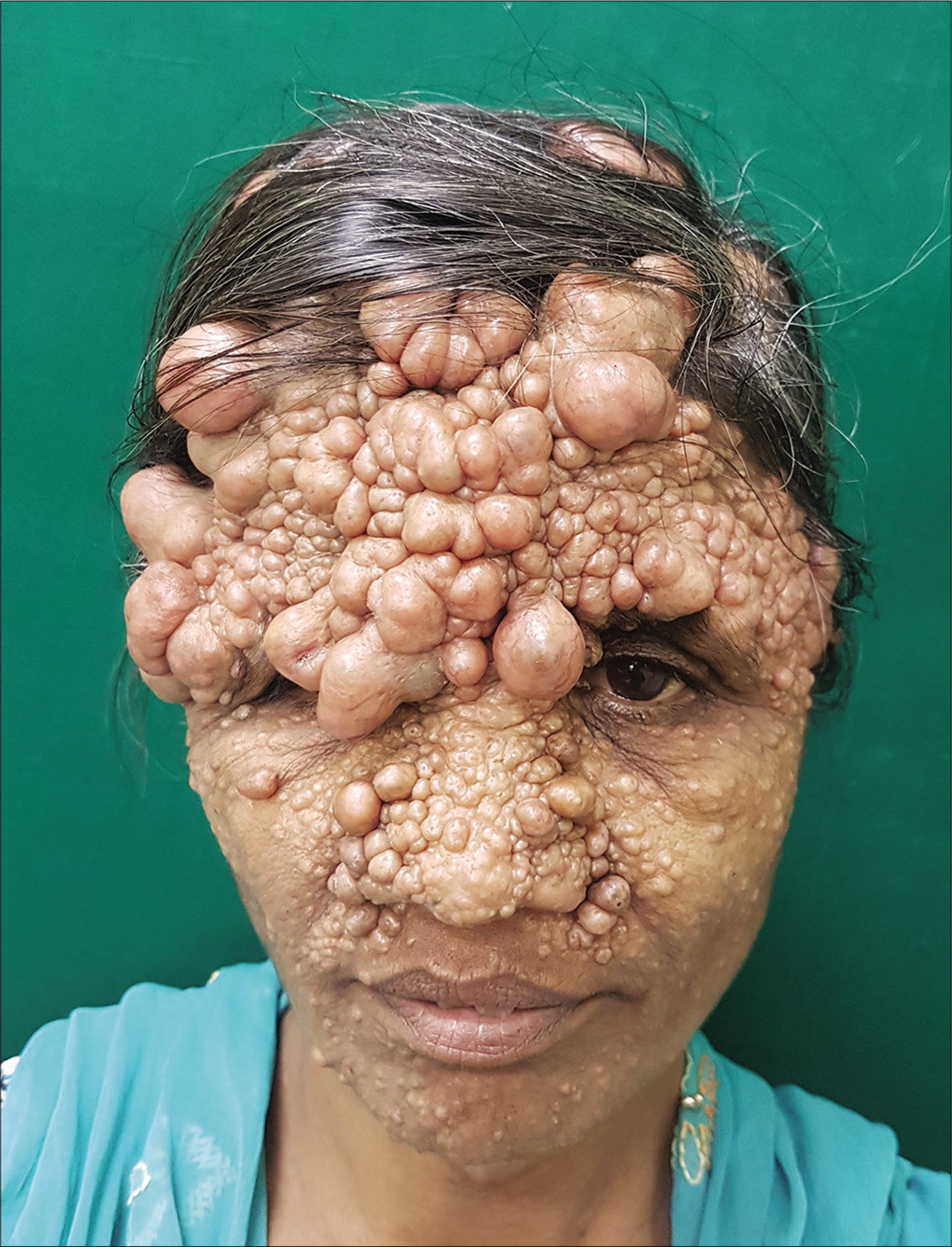 Multiple hairless, pinkish-red to skin coloured, dome-shaped, firm papules, nodules and tumoral lesions of varying sizes over scalp, forehead and face (predominantly over the nasolabial fold and nasal bridge)