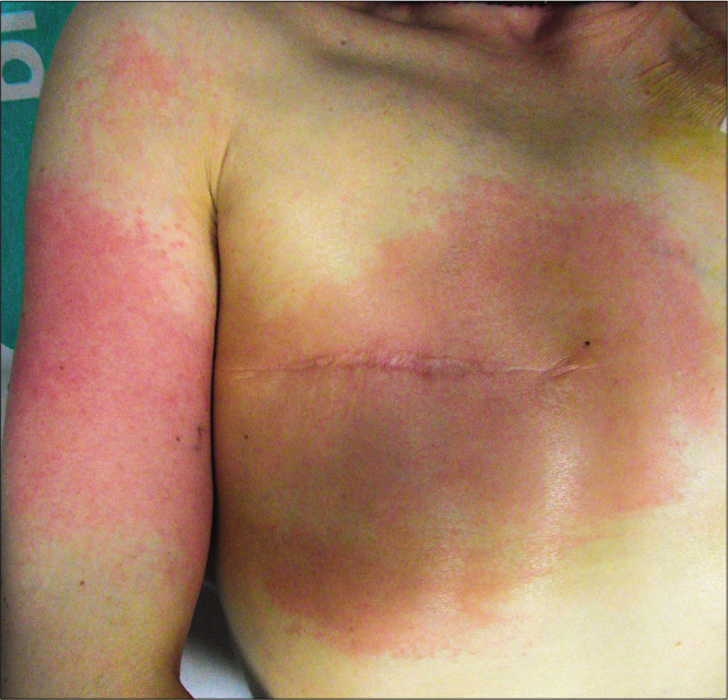 Erythematous indurated plaques with patched involvement of right pectoral, shoulder and upper arm affected by postmastectomy lymphedema