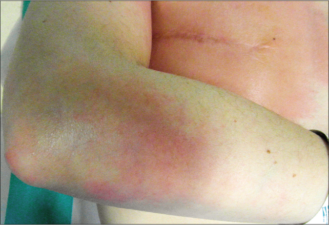 Erythematous indurated plaque on the forearm