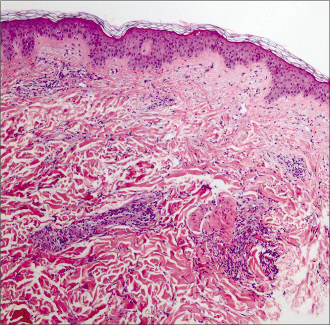 Preserved epidermis with perivascular and interstitial neutrophilic infiltrate, accompanied by edema of the papillary dermis without vasculitis (H and E, ×400)