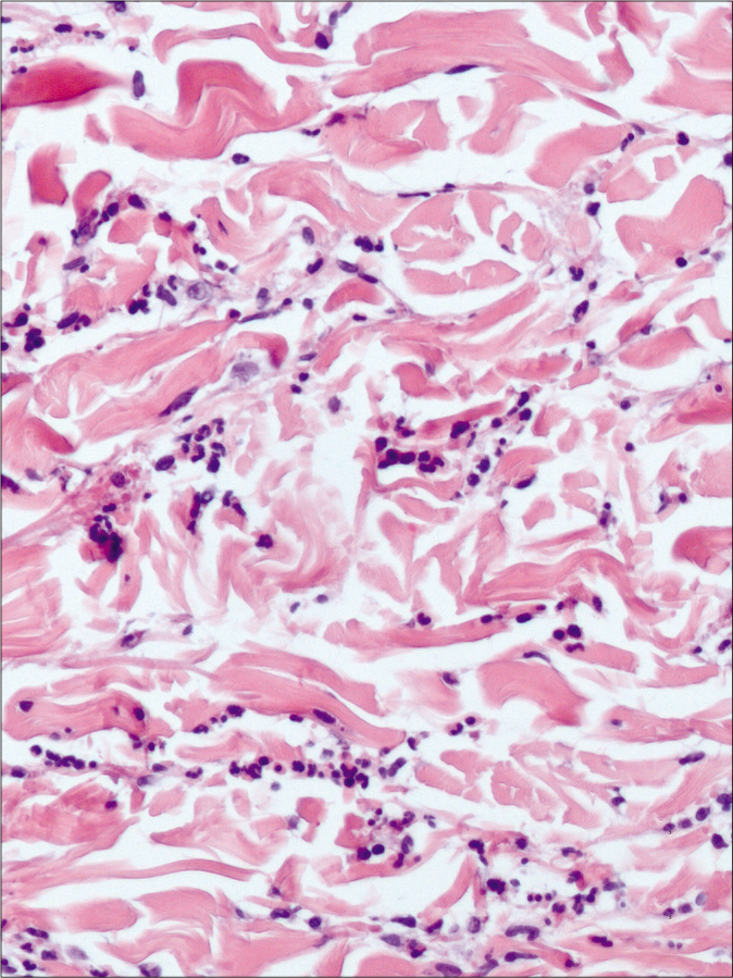 Neutrophilic dermal infiltrate (H and E, ×200)