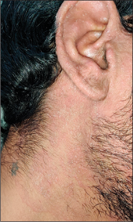 Ear sign. Auricular pinna involved in a case of tinea faciei