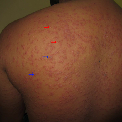 A closer view shows multiple targetoid lesions (blue arrows) and vesicles (red arrows)