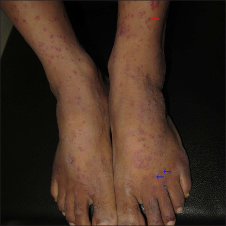 Multiple erythematous papules, vesicles (red arrow), and targetoid papules (blue arrows)