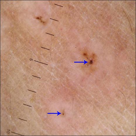 Dermoscopy under polarised mode (Heine Delta 20T, ×10 magnification) from targetoid papules shows a targetoid pattern comprising central brown peppering (arrows) and peripheral pinkish-white structureless area