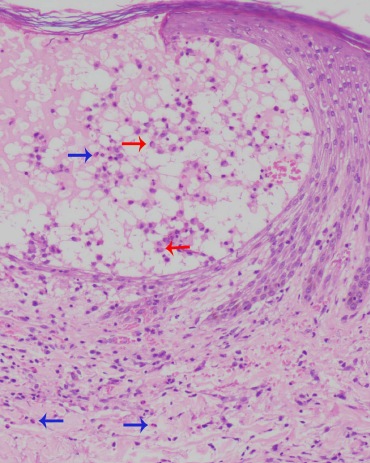 Erythrocyte extravasation and eosinophils (blue arrows). Red arrows point to the Langerhans cells (H & E, ×400)