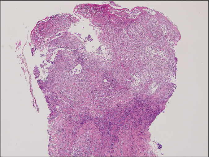 Ulcerative type revealed diffuse epidermal necrotic ulcer with neutrophilic infiltrations and dermal granulation tissue (haematoxylin and eosin stain, ×125)