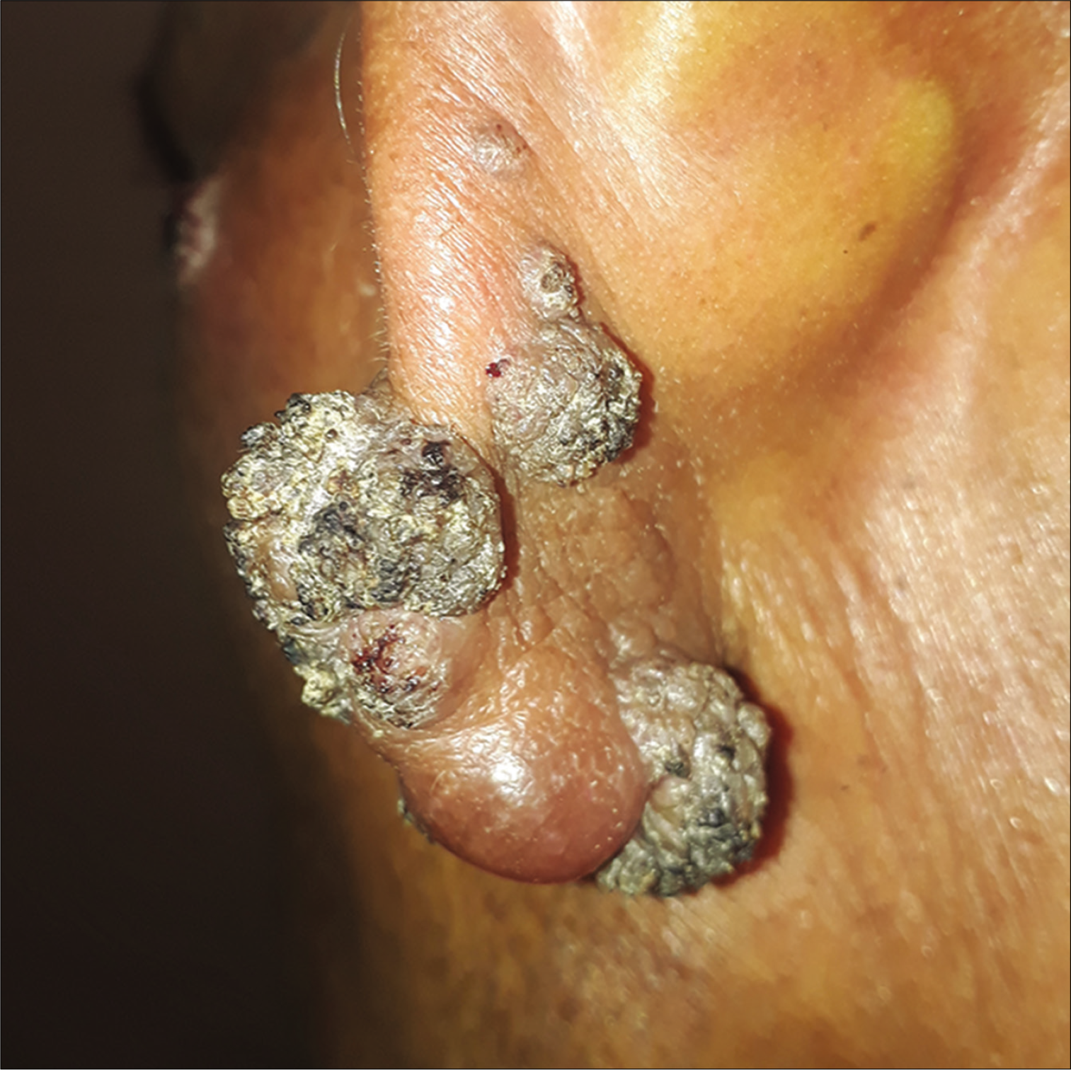 Multiple verrucous papular and nodular lesions on right pinna