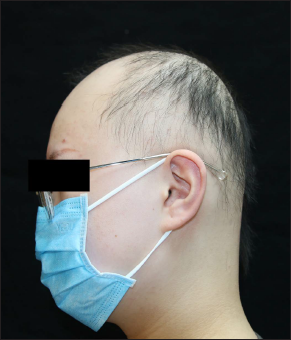 Extensive alopecia areata