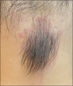 Obvious terminal hair growth within the area of a nevus flammeus on the occipital scalp