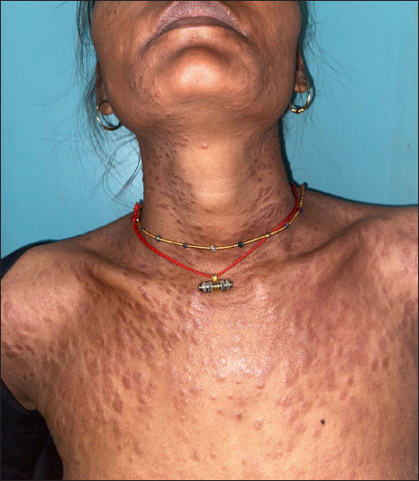 Multiple discrete shiny juicy red-brown papules over neck, trunk and extremities