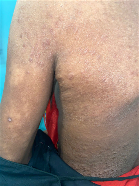 Multiple hypopigmented non-scaly macules with intact sensation over back