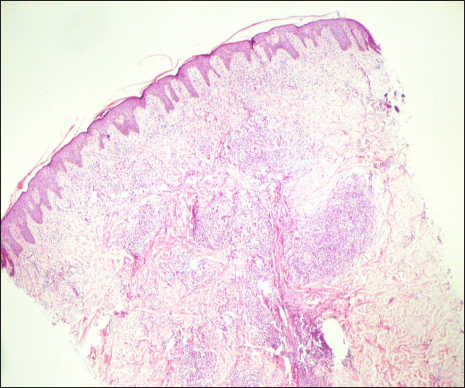 Perivascular and periadnexal well-defined granuloma composed of lymphocytes, foamy histiocytes and giant cells (haematoxylin and eosin, 4×)