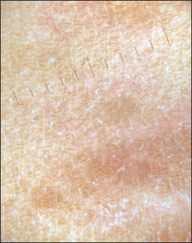 Dermoscopy using dermlite DL3 polarized mode show brown to slight orange hue from papule over chest