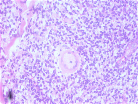 Well-defined granuloma composed of foamy histiocytes and Schaumann bodies within Langhans giant cells with no fungal elements (periodic acid-Schiff, 40×)