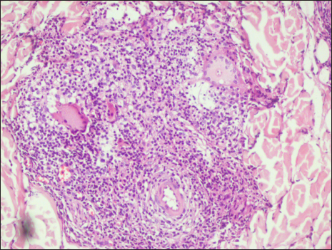 Perivascular and periadnexal well-defined granuloma composed of foamy histiocytes and Schaumann bodies within Langhans giant cells (Haematoxylin and eosin, 40×)