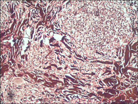 Reticulin stain positivity