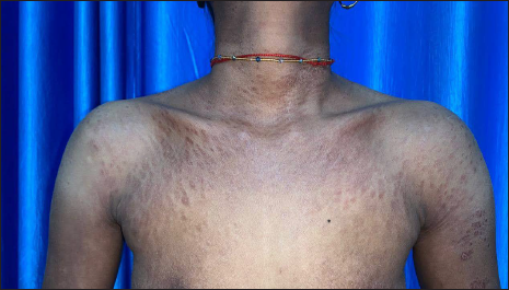 Decrease in thickness and number of papules over neck and chest