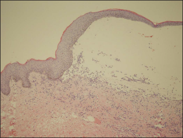 Histopathology showing sub-epidermal blister with neutrophil infiltration in the superficial dermis (H&E, 400×)