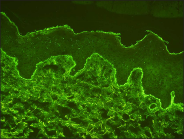 Direct immunofluorescence showing linear deposition of IgA within the basement membrane zone (400×)