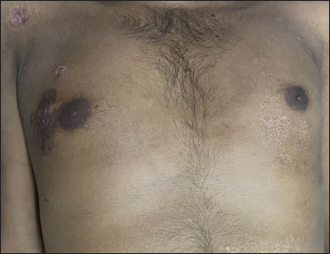 Dyspigmented plaques on the right chest and shoulder, and guttate hypopigmented papules on the left chest