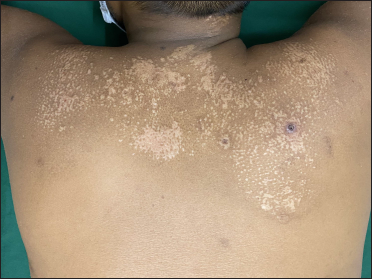 Guttate hypopigmented papules, and some coalescing to form plaques, on the upper back